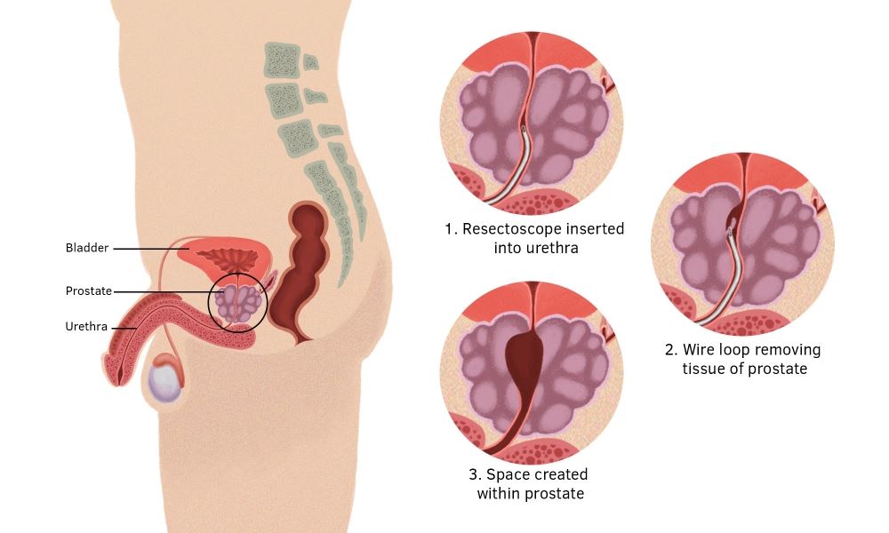 Prostate-Diseases